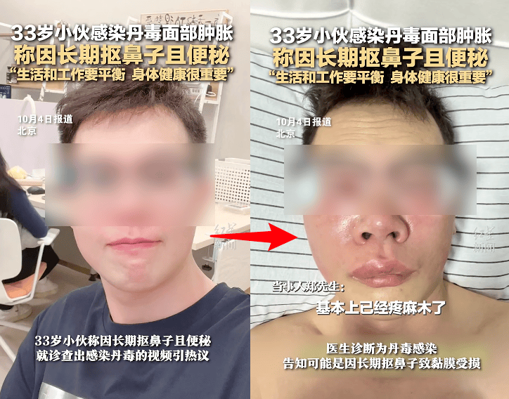 烂腿预警！东莞一男子游泳后小腿染上丹毒，变得红肿热痛，行走都困难！