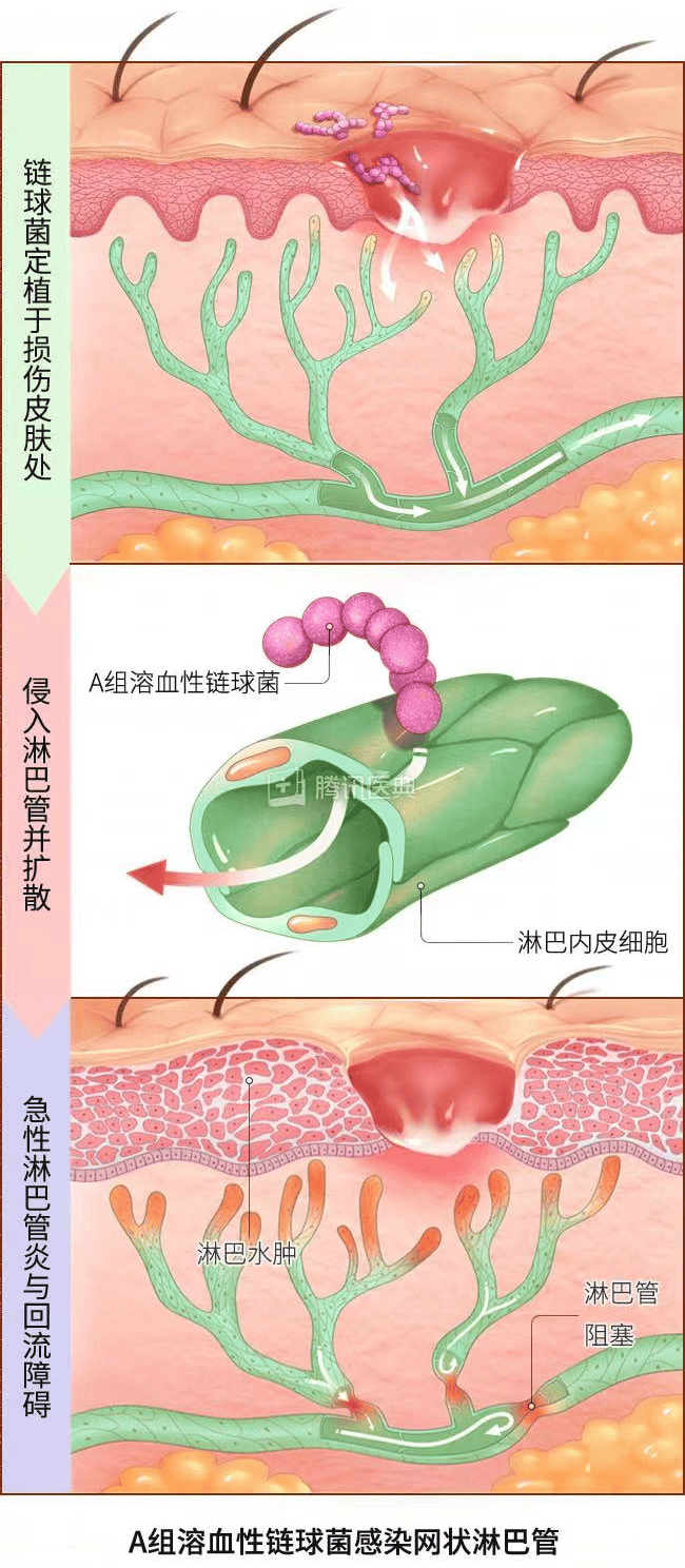 烂腿预警！东莞一男子游泳后小腿染上丹毒，变得红肿热痛，行走都困难！